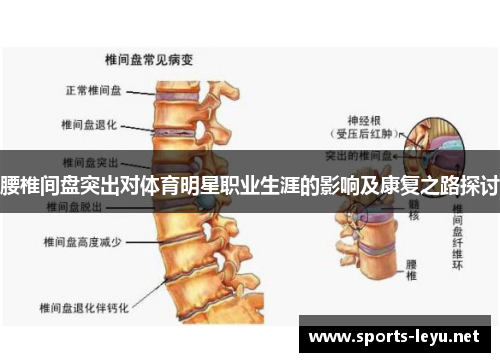腰椎间盘突出对体育明星职业生涯的影响及康复之路探讨